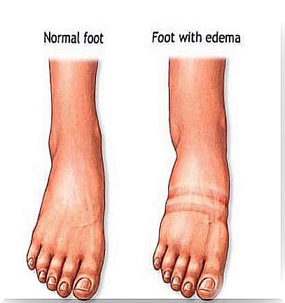 Edema feet