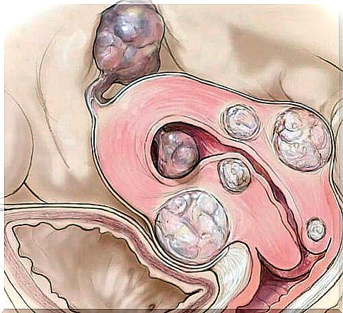 Image of muscle knots in the uterus