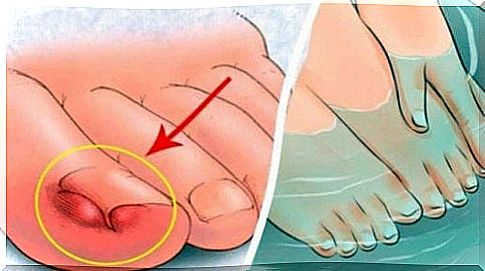 6 homemade remedies to soothe ingrown toenails