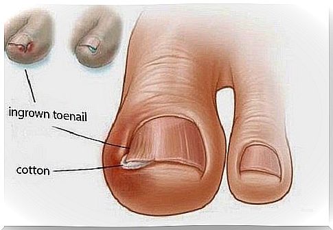 6 old remedies for ingrown toenails