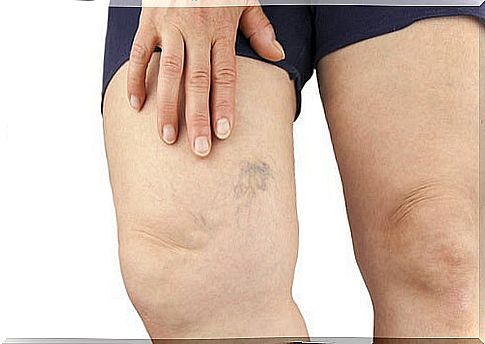 Woman with ruptured vein on thigh