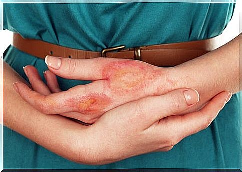 Woman with infection on hand