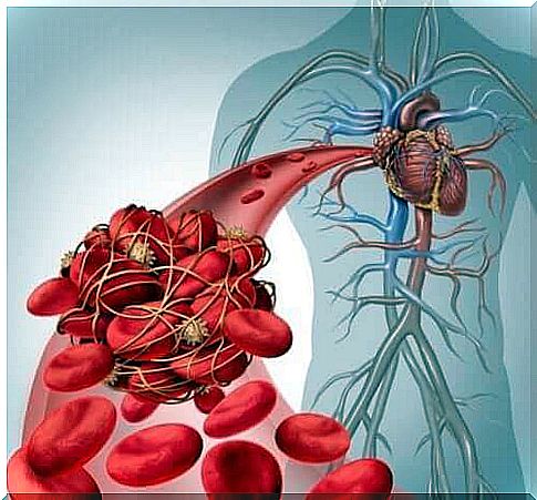 Diagram shows deep vein thrombosis