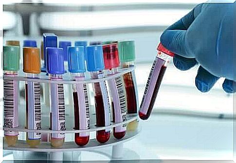 Laboratory assistant handles blood samples with deep vein thrombosis