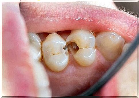 Close-up of hole in tooth