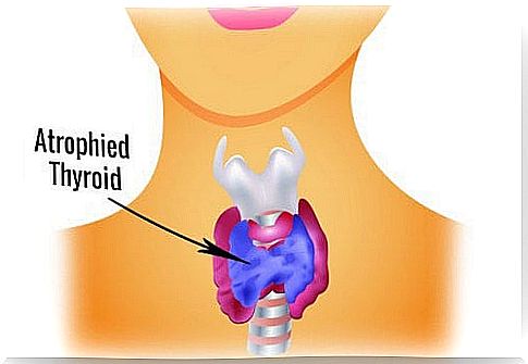 Atrophy Thyroid