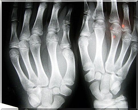 The row of fingers with osteoarthritis