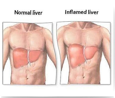 Liver enlargement: Symptoms and proper diet