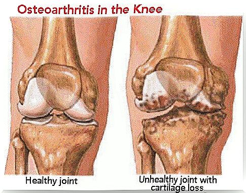 Rheumatism