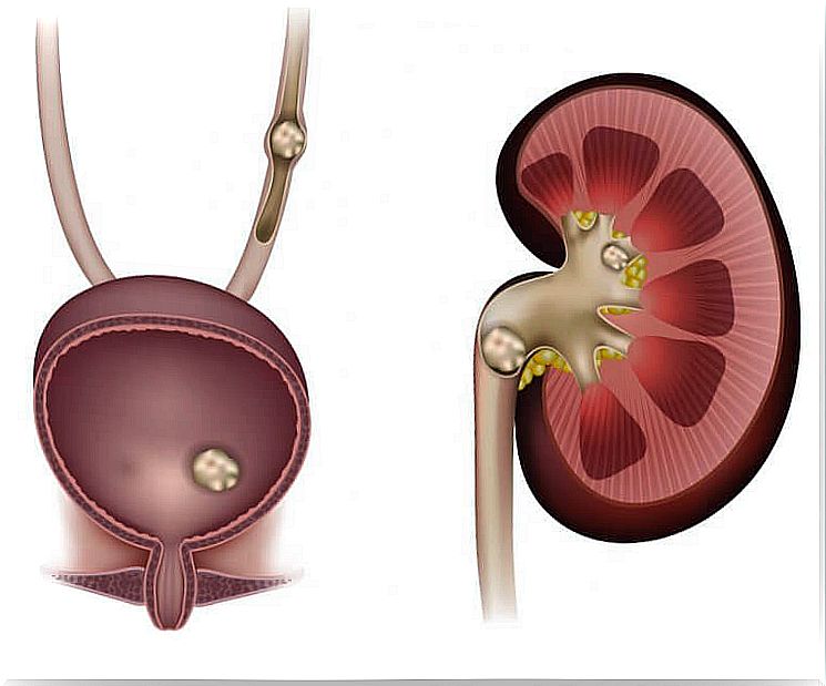 Prevent kidney stones with lemon, olive oil and apple cider vinegar