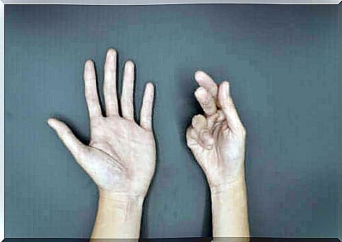 Reasons for Dupuytren's contracture and its treatments