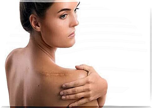 Woman with scars on shoulder