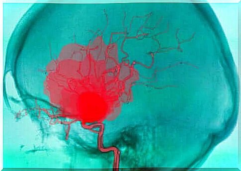 What is a cerebral haemorrhage and why does it occur?