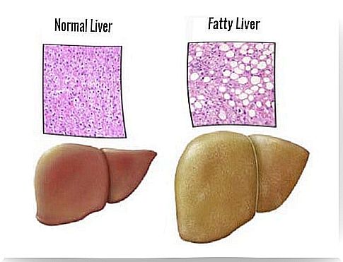 Fatty liver